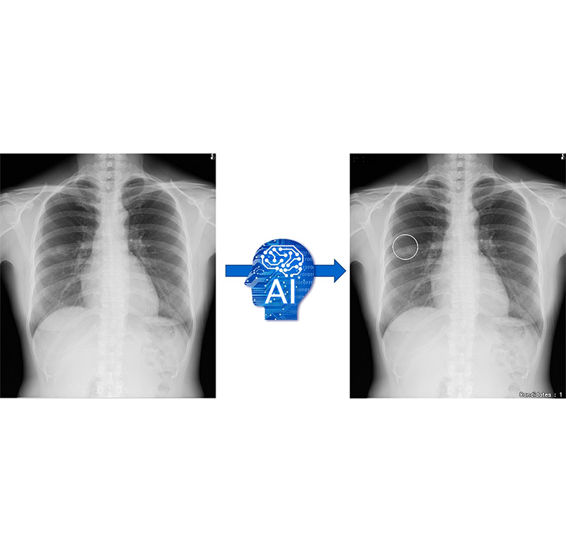 胸部X線AI診断