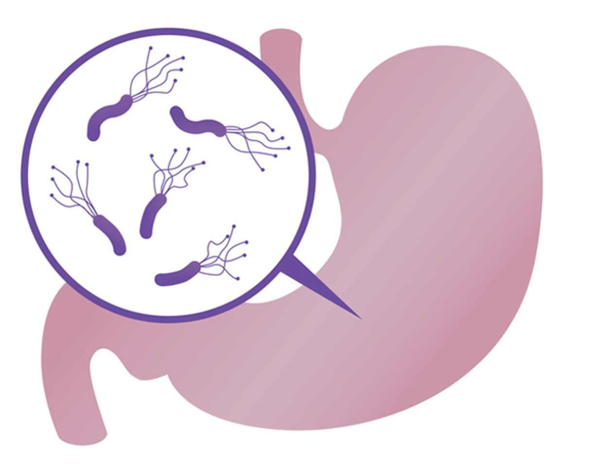 胃・十二指腸潰瘍の検査方法