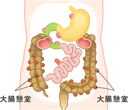 大腸憩室とは？